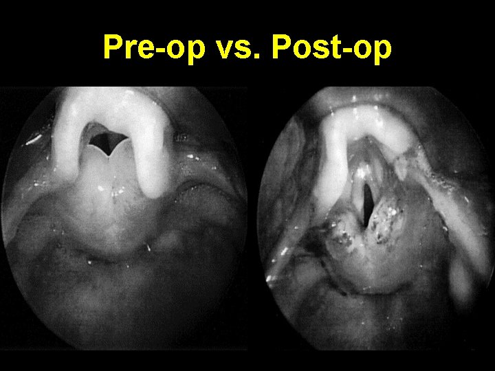 Pre-op vs. Post-op 