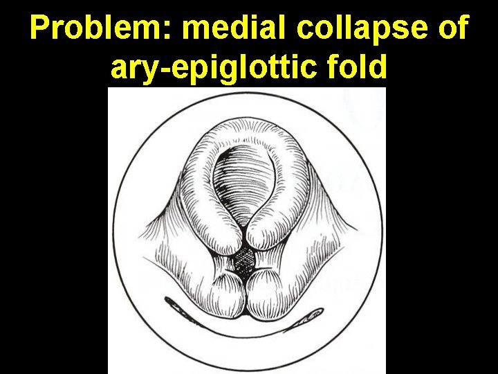 Problem: medial collapse of ary-epiglottic fold 