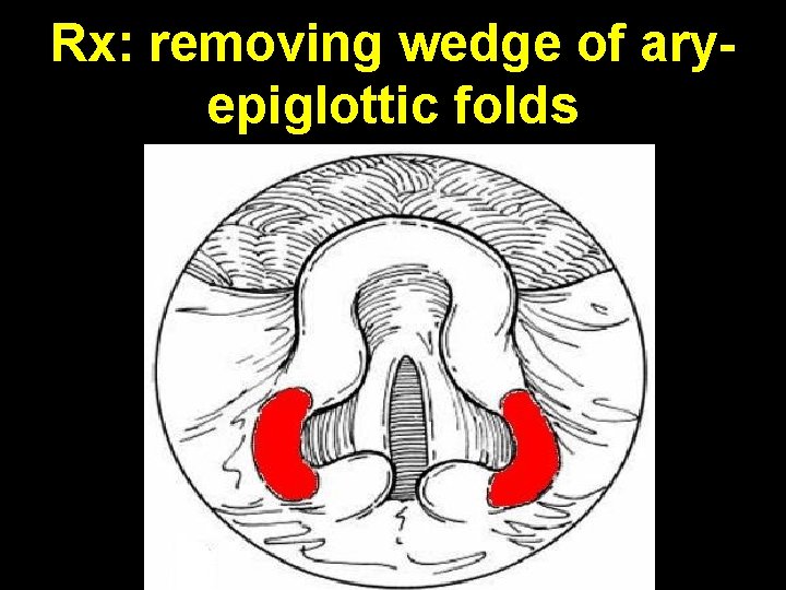 Rx: removing wedge of aryepiglottic folds 