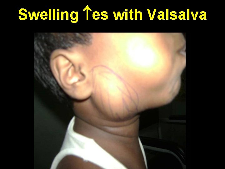 Swelling es with Valsalva 