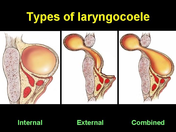 Types of laryngocoele Internal External Combined 