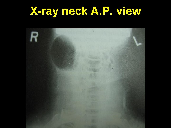 X-ray neck A. P. view 