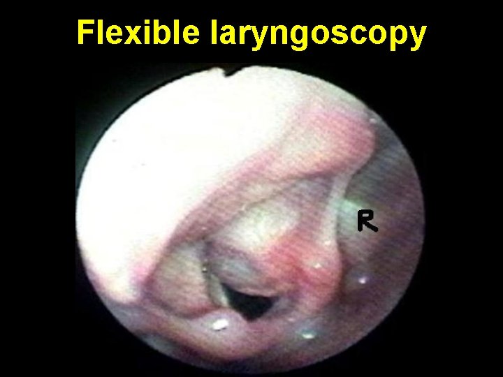 Flexible laryngoscopy 