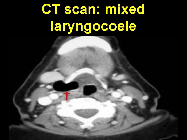 CT scan: mixed laryngocoele 