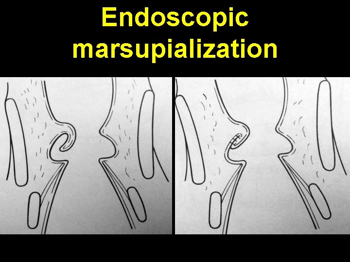Endoscopic marsupialization 