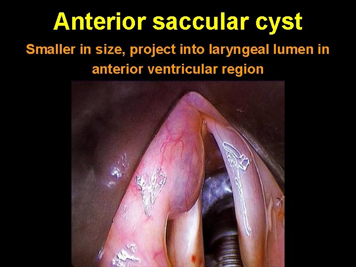 Anterior saccular cyst Smaller in size, project into laryngeal lumen in anterior ventricular region