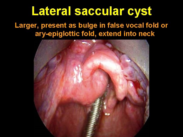 Lateral saccular cyst Larger, present as bulge in false vocal fold or ary-epiglottic fold,