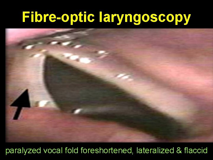 Fibre-optic laryngoscopy paralyzed vocal fold foreshortened, lateralized & flaccid 