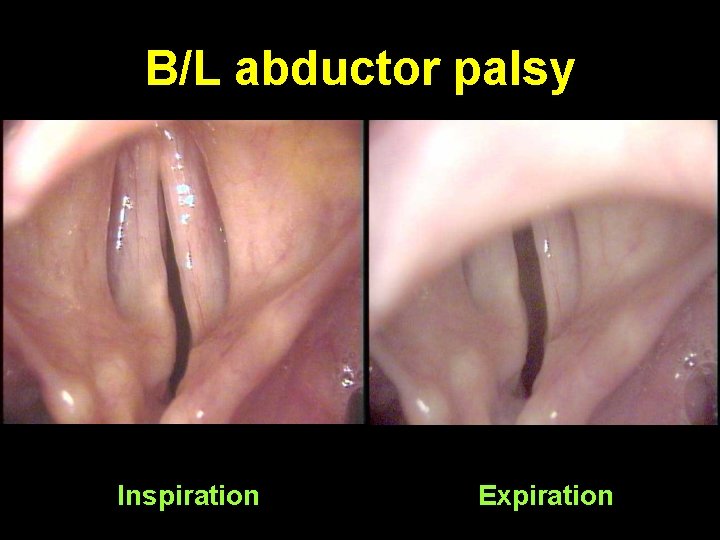 B/L abductor palsy Inspiration Expiration 
