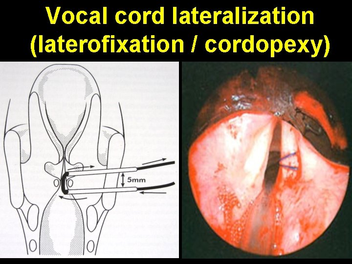 Vocal cord lateralization (laterofixation / cordopexy) 