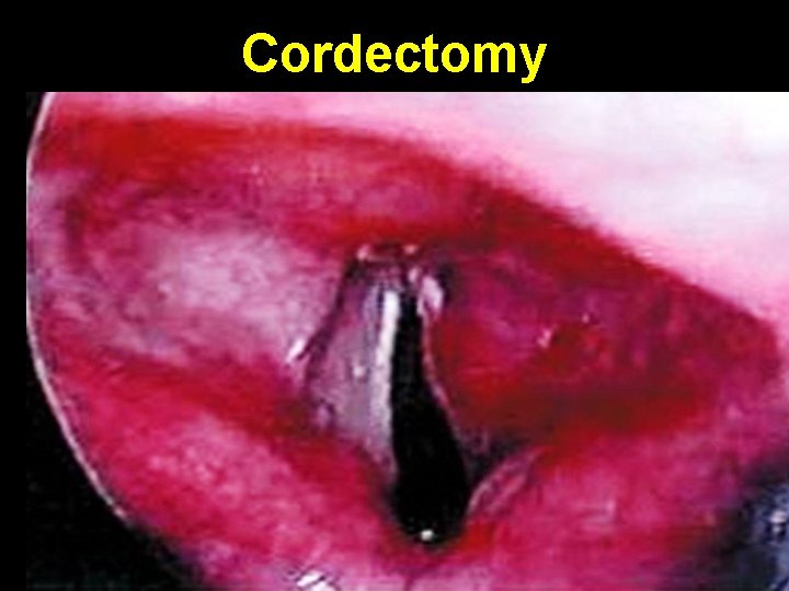 Cordectomy 