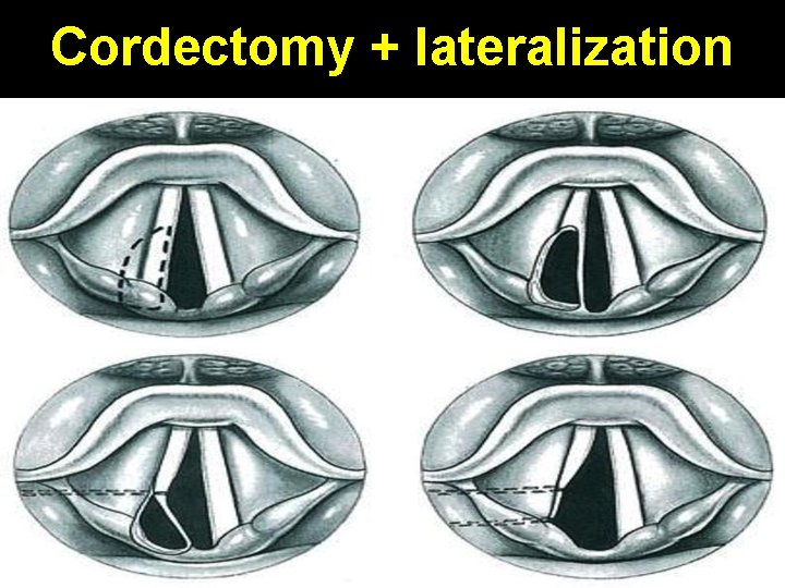 Cordectomy + lateralization 