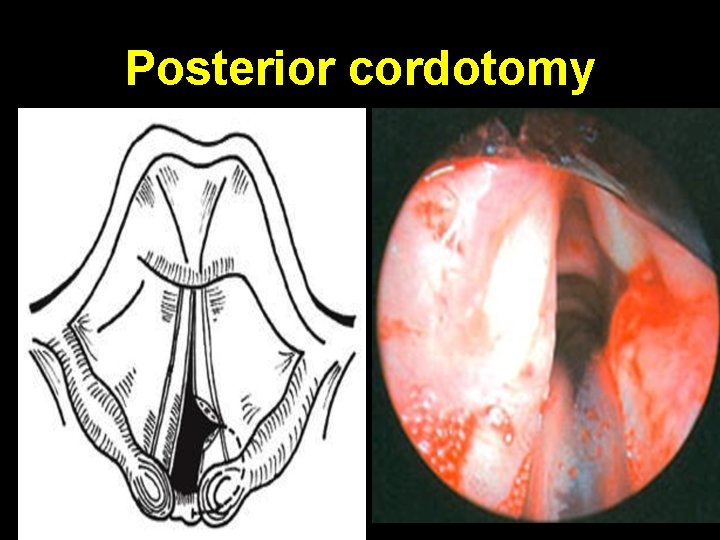 Posterior cordotomy 