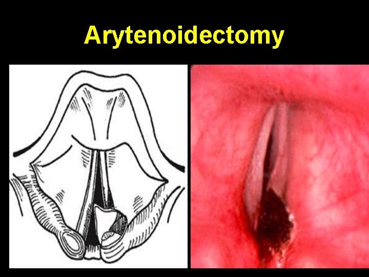 Arytenoidectomy 