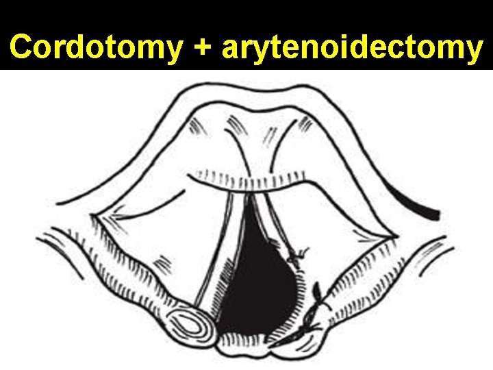 Cordotomy + arytenoidectomy 