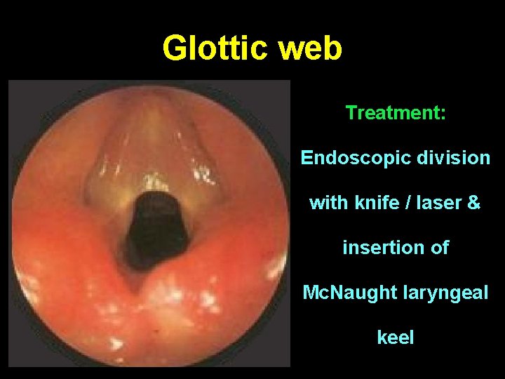 Glottic web Treatment: Endoscopic division with knife / laser & insertion of Mc. Naught