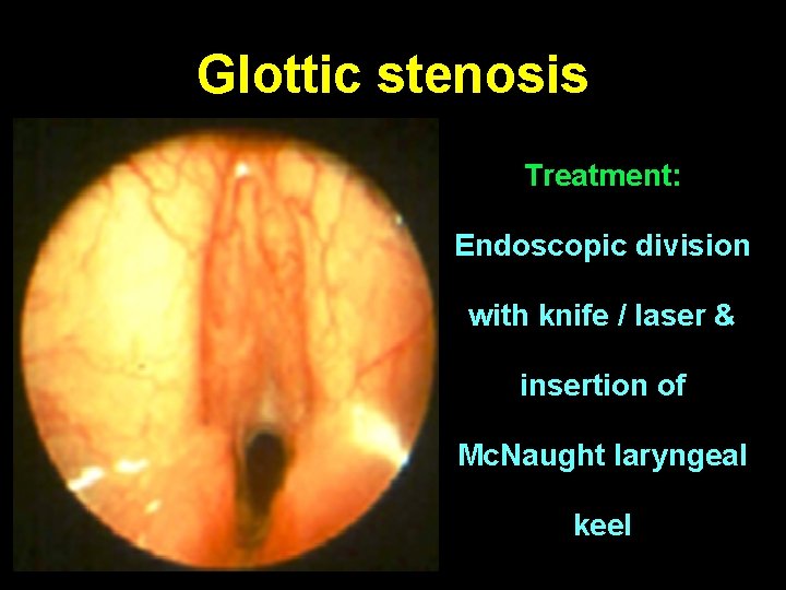 Glottic stenosis Treatment: Endoscopic division with knife / laser & insertion of Mc. Naught