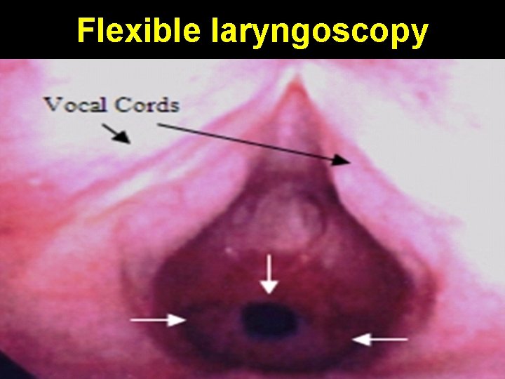 Flexible laryngoscopy 