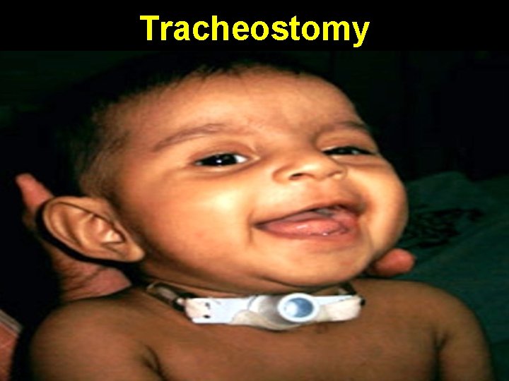 Tracheostomy 