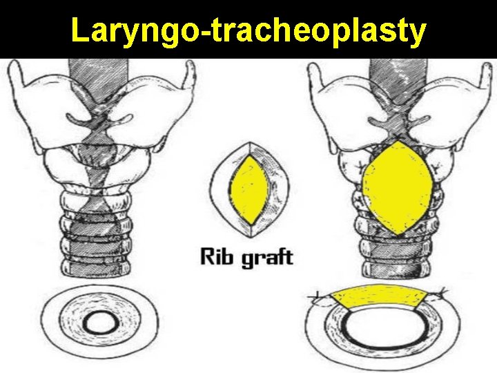 Laryngo-tracheoplasty 