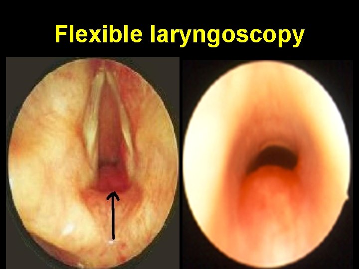 Flexible laryngoscopy 