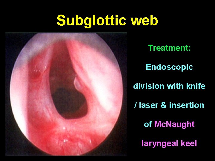 Subglottic web Treatment: Endoscopic division with knife / laser & insertion of Mc. Naught