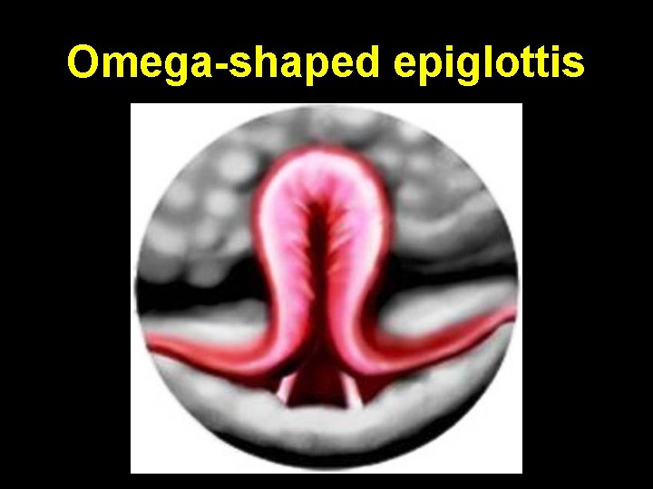 Omega-shaped epiglottis 