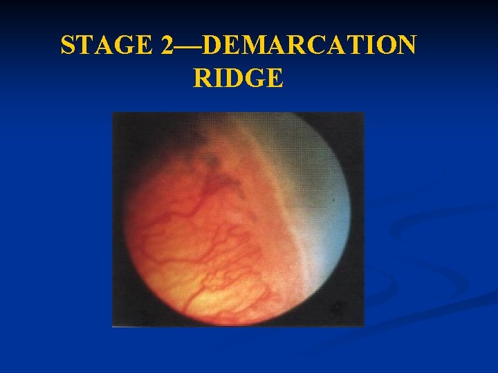 STAGE 2—DEMARCATION RIDGE STAGE 2—DEMARCATION RIDGE