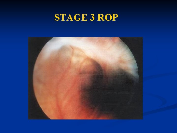 STAGE 3 ROP STAGE 3 ROP