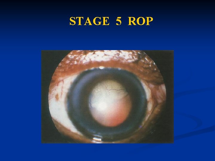 STAGE 5 ROP STAGE 5 ROP