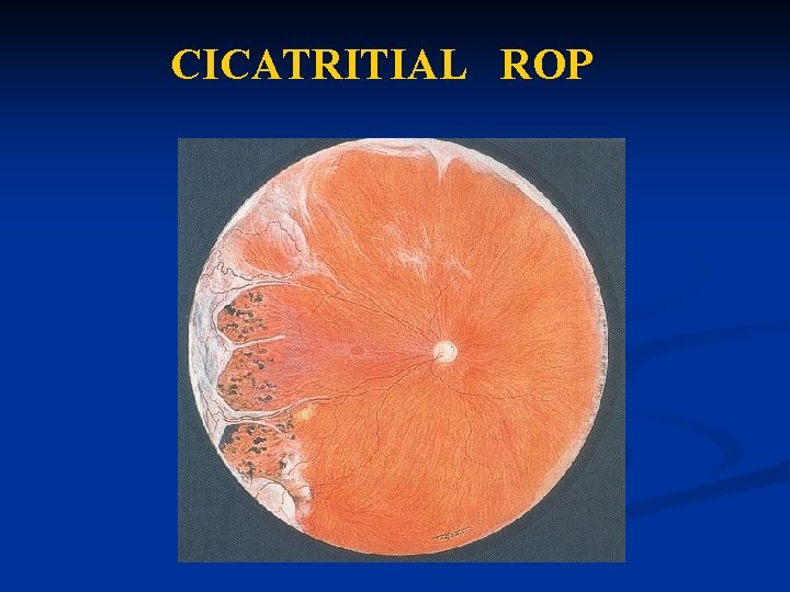 CICATRITIAL ROP CICATRITIAL ROP