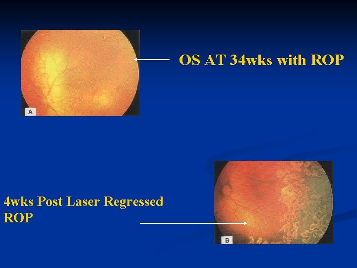 OS AT 34 wks with ROP 4 wks Post Laser Regressed ROP OS AT 34 wks with ROP 4 wks Post Laser Regressed ROP