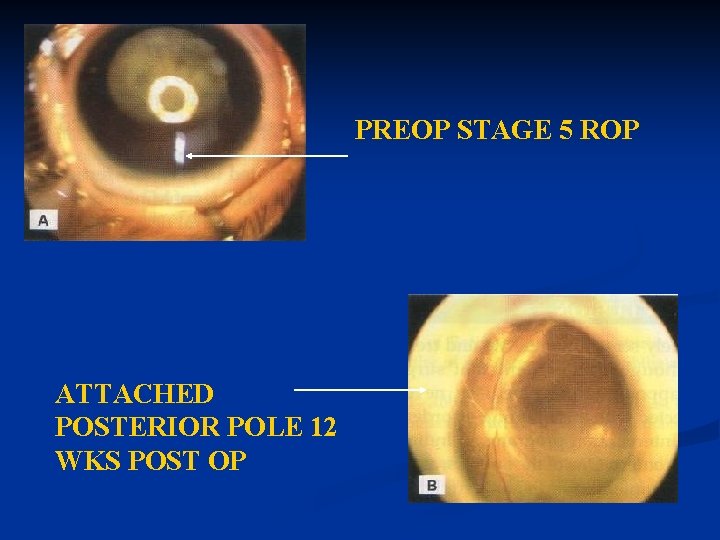 PREOP STAGE 5 ROP ATTACHED POSTERIOR POLE 12 WKS POST OP PREOP STAGE 5 ROP ATTACHED POSTERIOR POLE 12 WKS POST OP