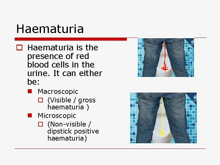 Haematuria o Haematuria is the presence of red blood cells in the urine. It