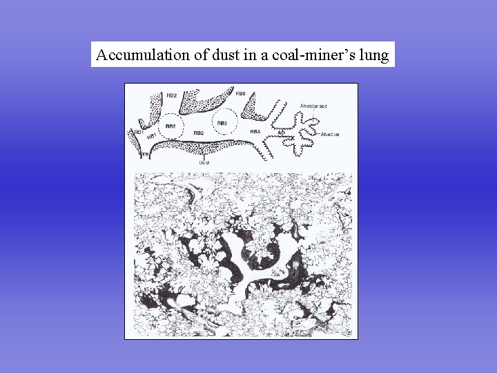 Accumulation of dust in a coal-miner’s lung 