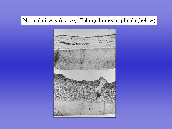 Normal airway (above); Enlarged mucous glands (below) 