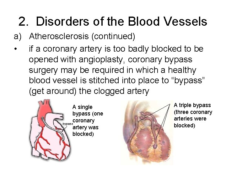 2. Disorders of the Blood Vessels a) Atherosclerosis (continued) • if a coronary artery