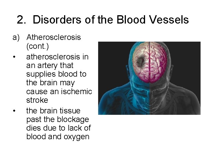2. Disorders of the Blood Vessels a) Atherosclerosis (cont. ) • atherosclerosis in an