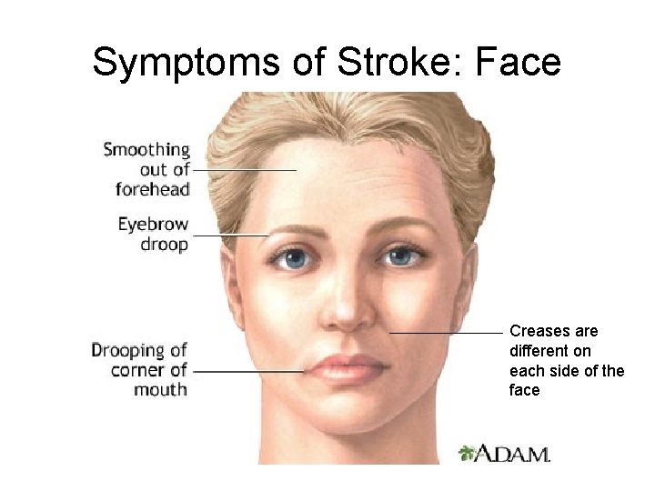 Symptoms of Stroke: Face Creases are different on each side of the face 