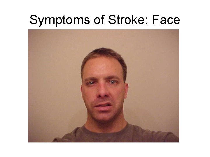 Symptoms of Stroke: Face 