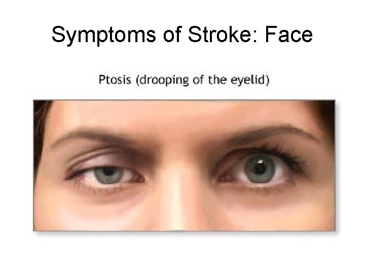 Symptoms of Stroke: Face 