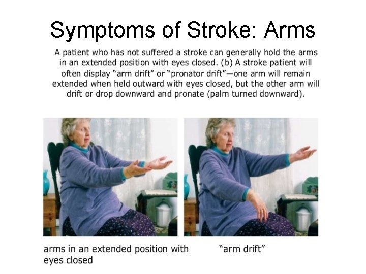 Symptoms of Stroke: Arms 