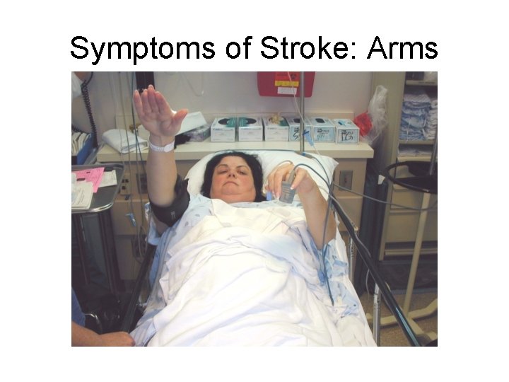 Symptoms of Stroke: Arms 