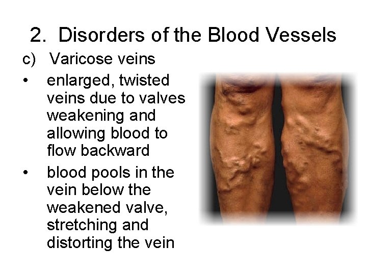 2. Disorders of the Blood Vessels c) Varicose veins • enlarged, twisted veins due