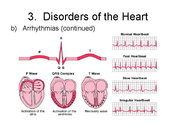 3. Disorders of the Heart b) Arrhythmias (continued) 