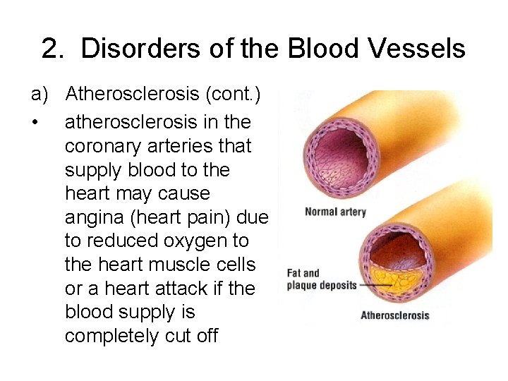 2. Disorders of the Blood Vessels a) Atherosclerosis (cont. ) • atherosclerosis in the
