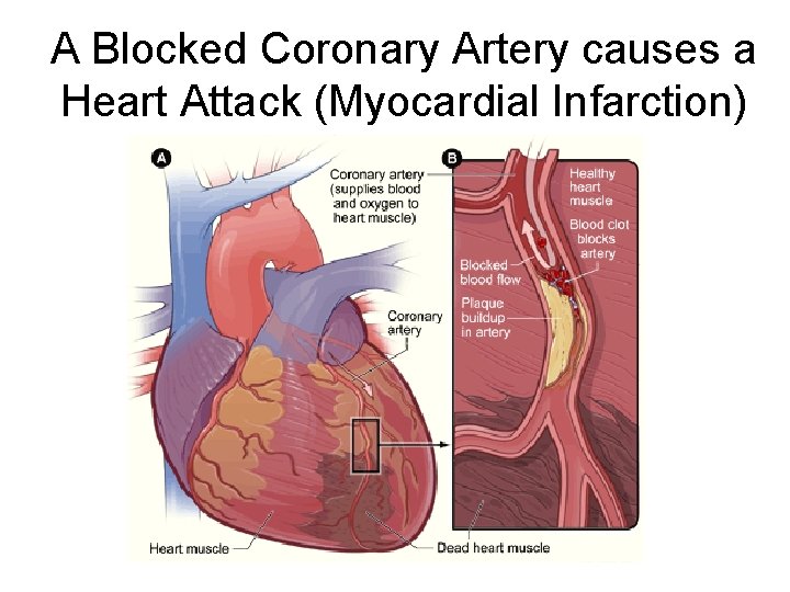 A Blocked Coronary Artery causes a Heart Attack (Myocardial Infarction) 