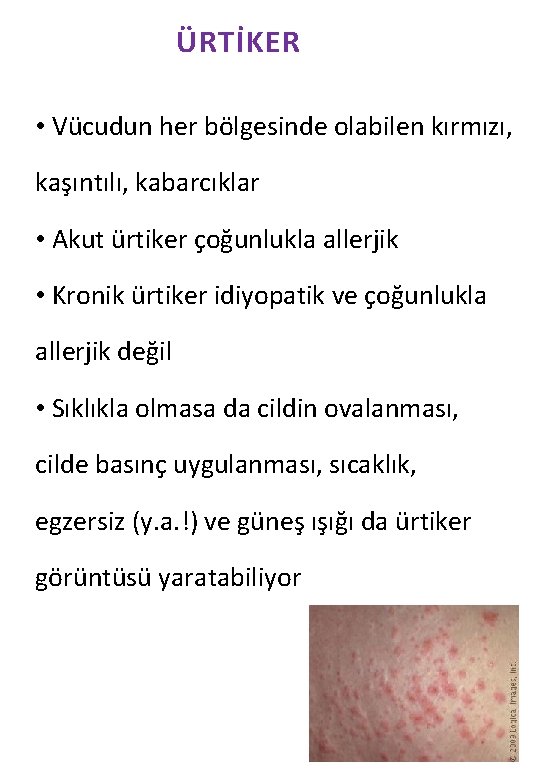 ÜRTİKER • Vücudun her bölgesinde olabilen kırmızı, kaşıntılı, kabarcıklar • Akut ürtiker çoğunlukla allerjik