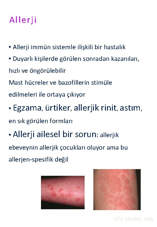 Allerji • Allerji immün sistemle ilişkili bir hastalık • Duyarlı kişilerde görülen sonradan kazanılan,