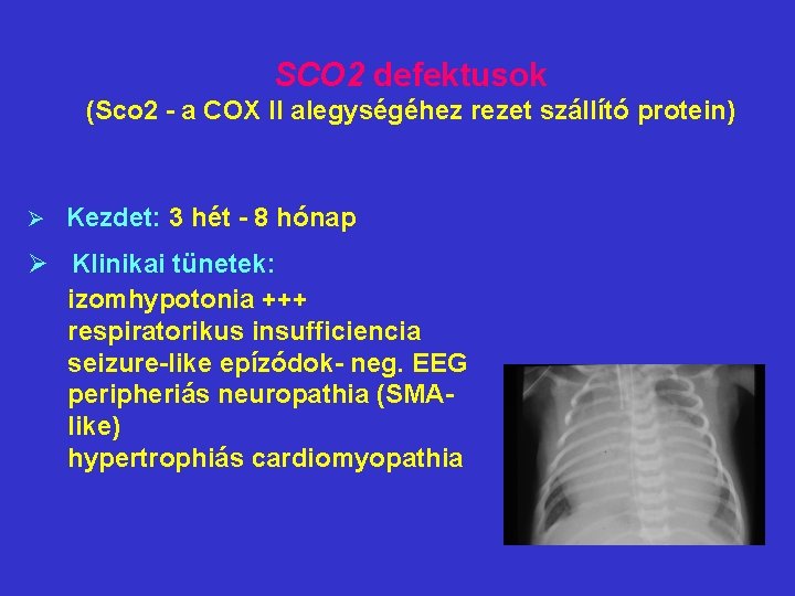 SCO 2 defektusok (Sco 2 - a COX II alegységéhez rezet szállító protein) Ø